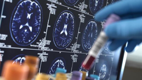 痴呆症:研究人员发现了阿尔茨海默氏症的一个重要风险基因